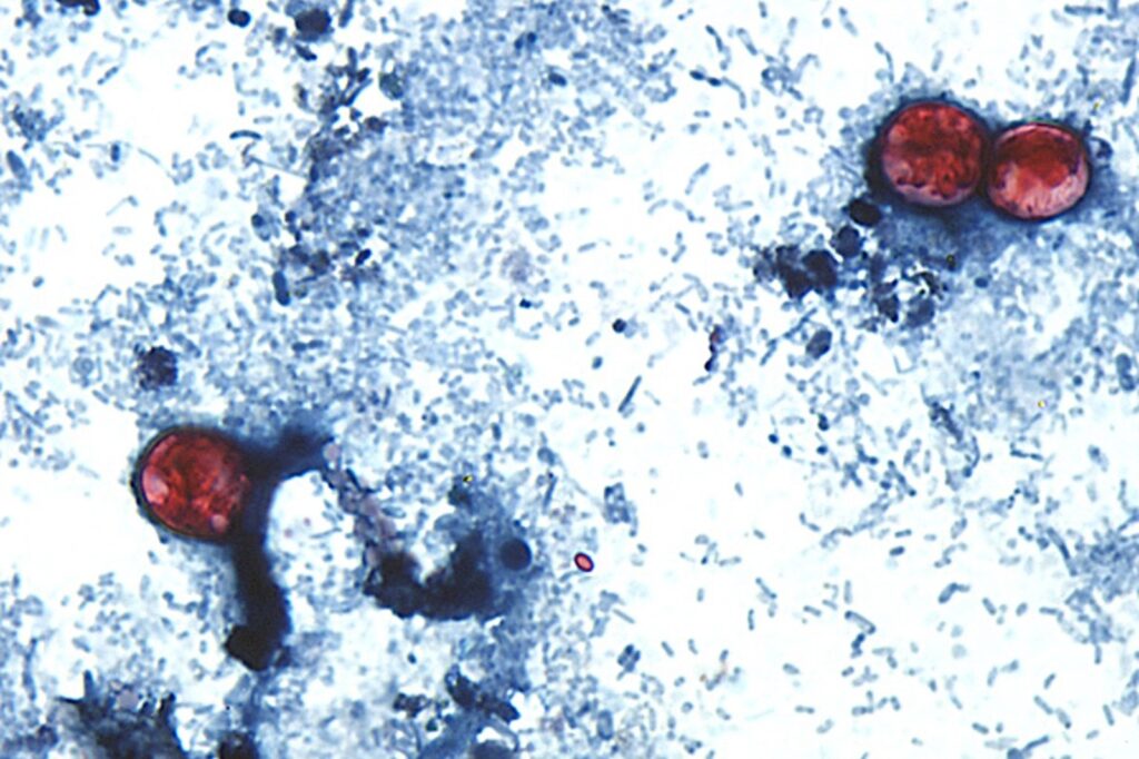 The Summer Cyclospora Outbreak: What You Need to Know
